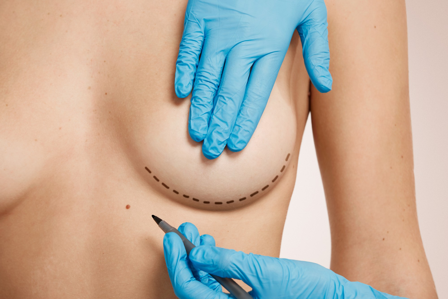 Breast Implants in Miami Breast Implants in Miami