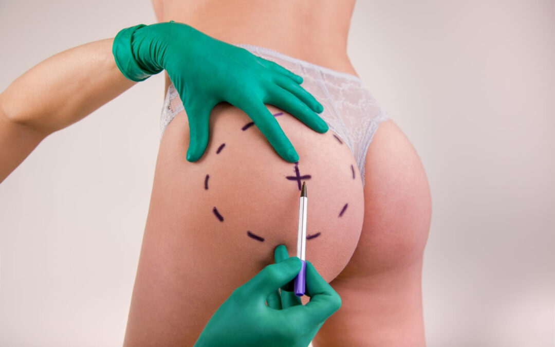 Butt Augmentation: Butt Implant Incision Location to Reduce Scarring