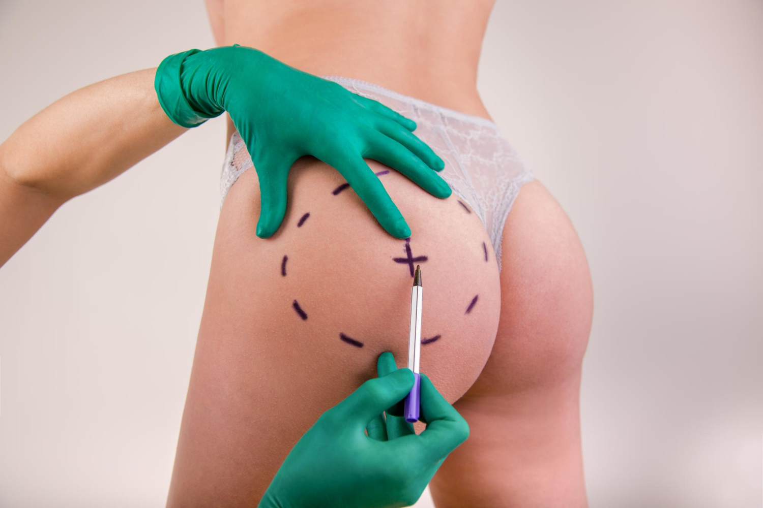 butt augmentation options with Dr. Mendieta