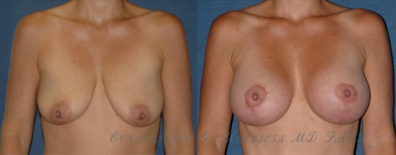 BREAST-AUGMENTATION-WITH-LIFT-32