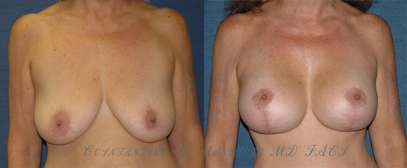 BREAST-AUGMENTATION-WITH-LIFT-41