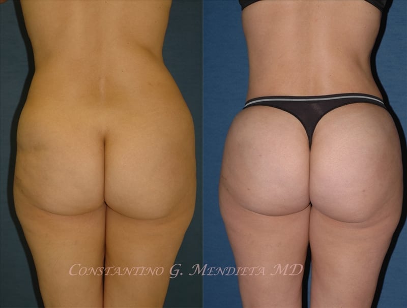 BUTT-AUGMENTATION-101a