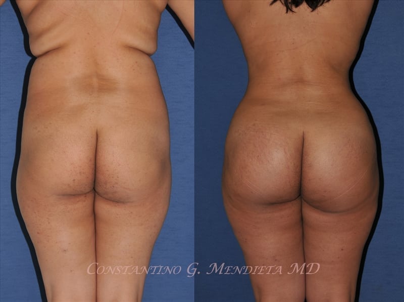 Before and after butt augmentation example 1