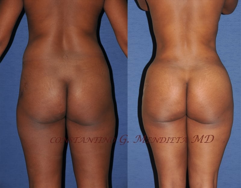 BUTT-AUGMENTATION-106