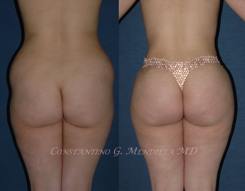 Before and after butt augmentation example 1