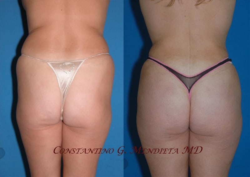 BUTT-AUGMENTATION-97 Before and after butt augmentation example 1