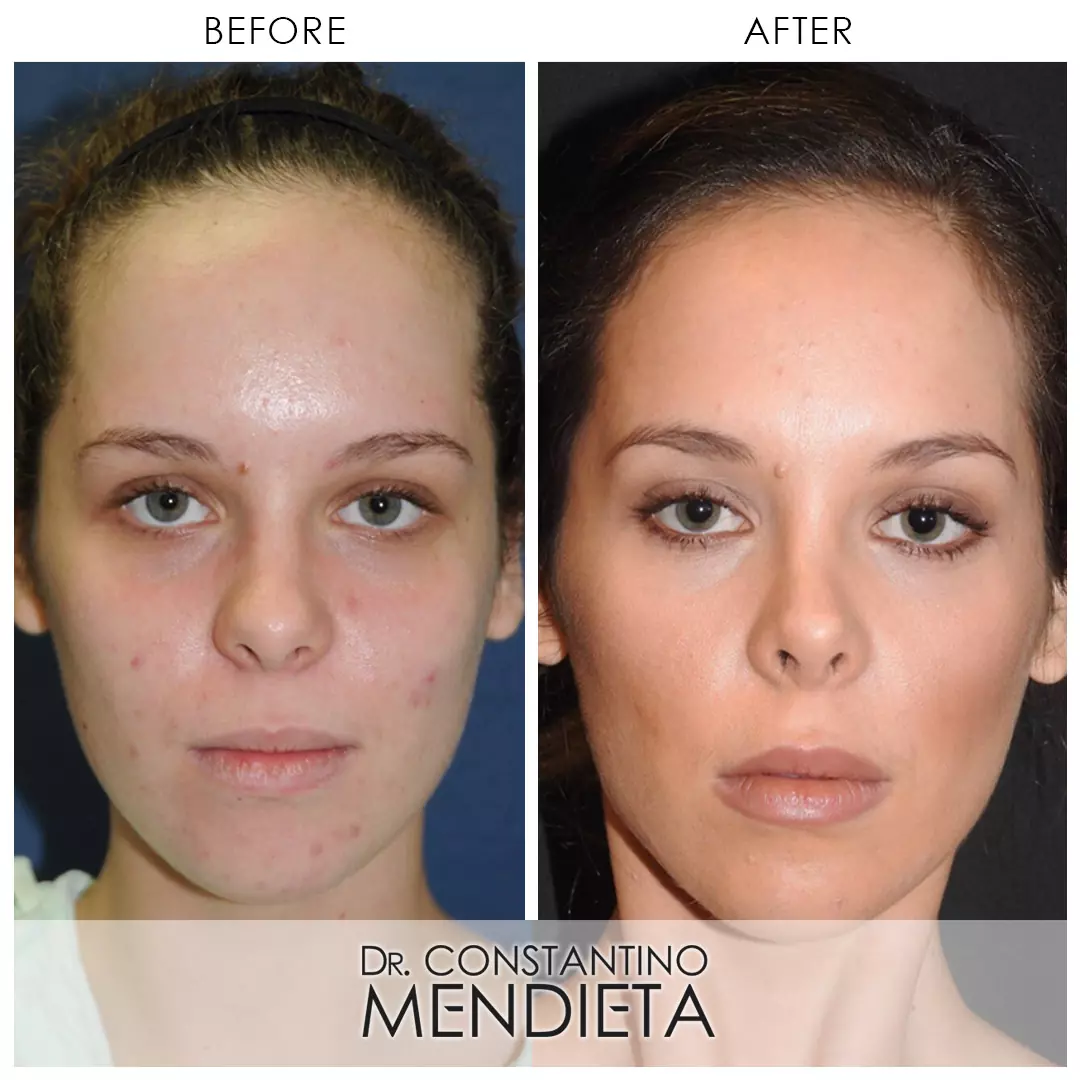 Facial Before and after