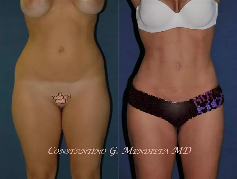 Liposuction Before and After