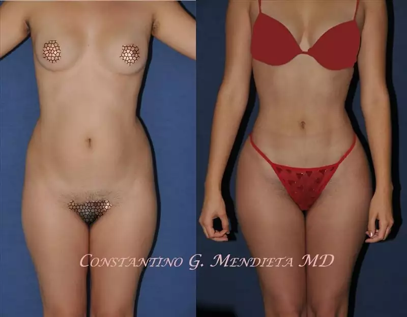 Liposuction Before and After