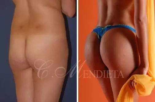 Miami Thong Lift