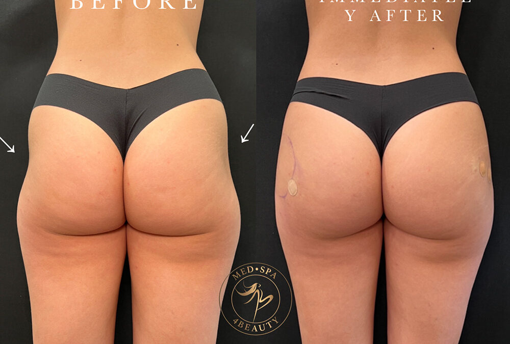 Hate Your Hip Dips? Here Are Your Options