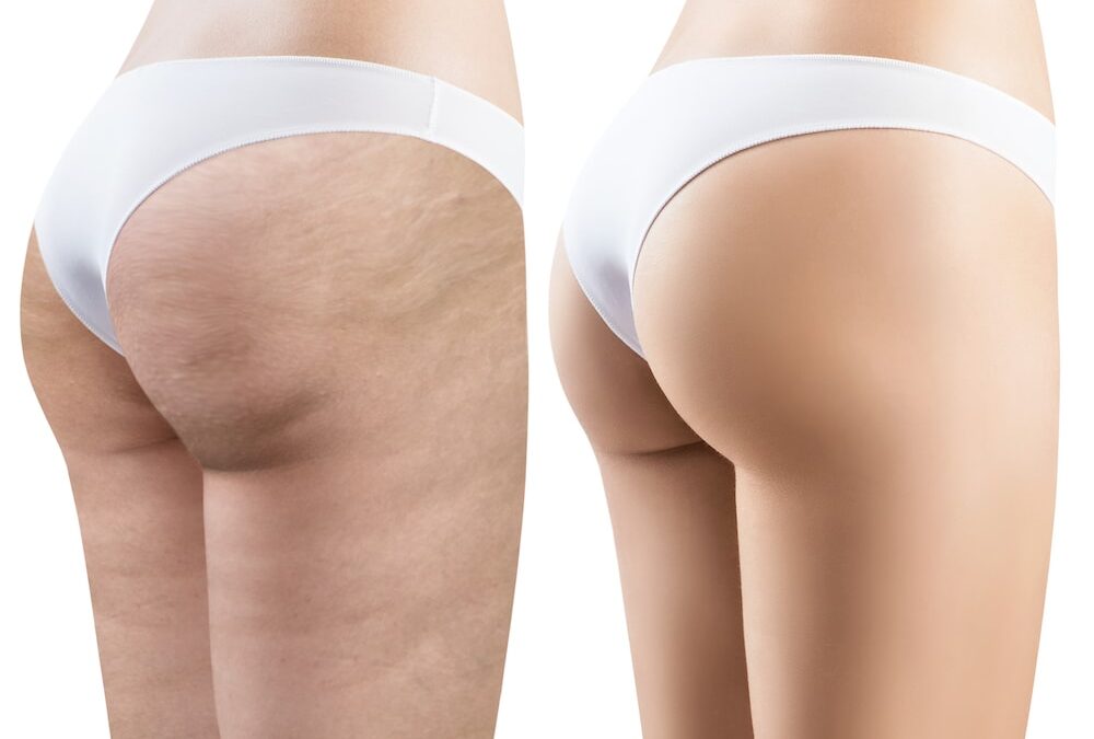 Can a Mommy Makeover Get Rid of Cellulite?