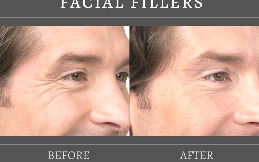 The Best Cosmetic Fillers for the Fall Season