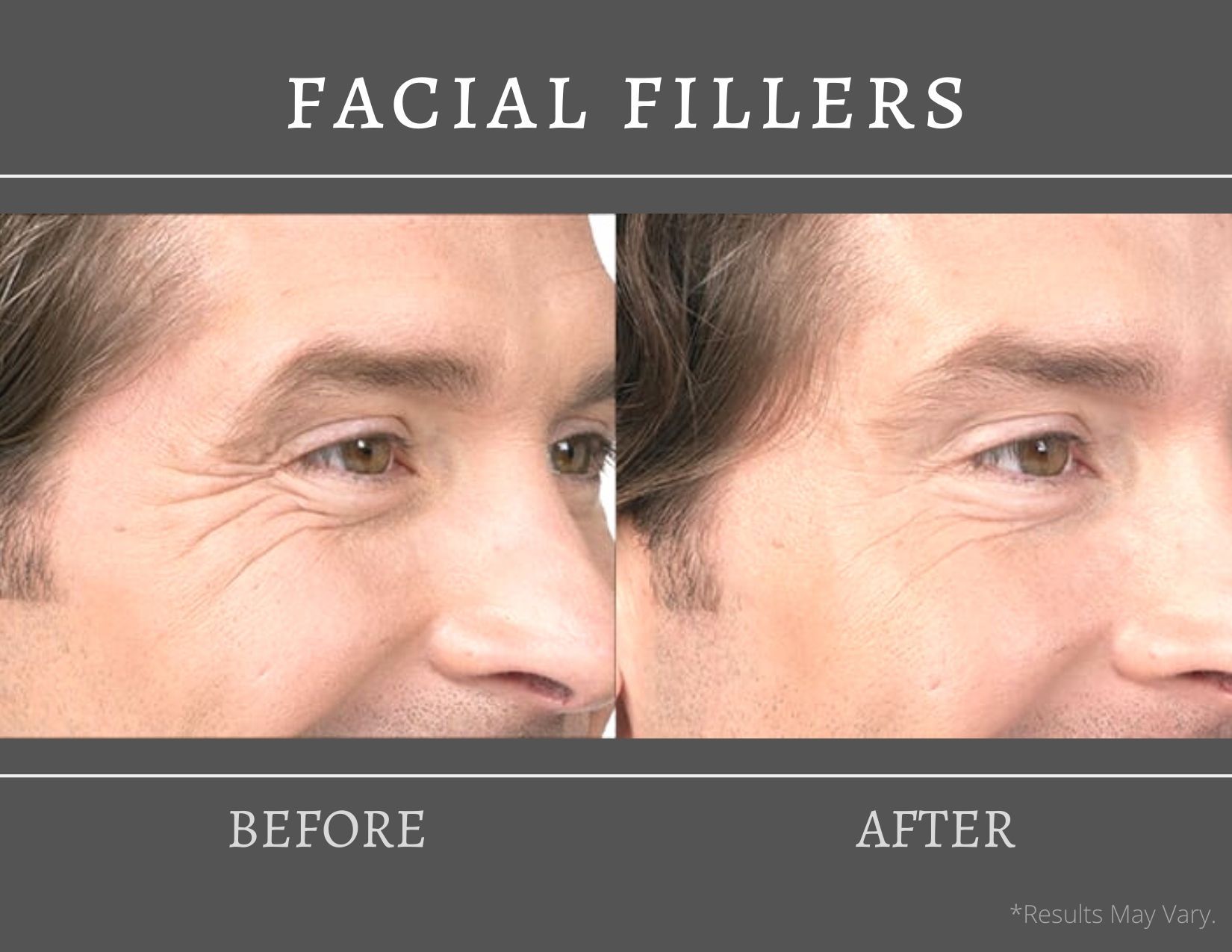 The Best Cosmetic Fillers for the Fall Season