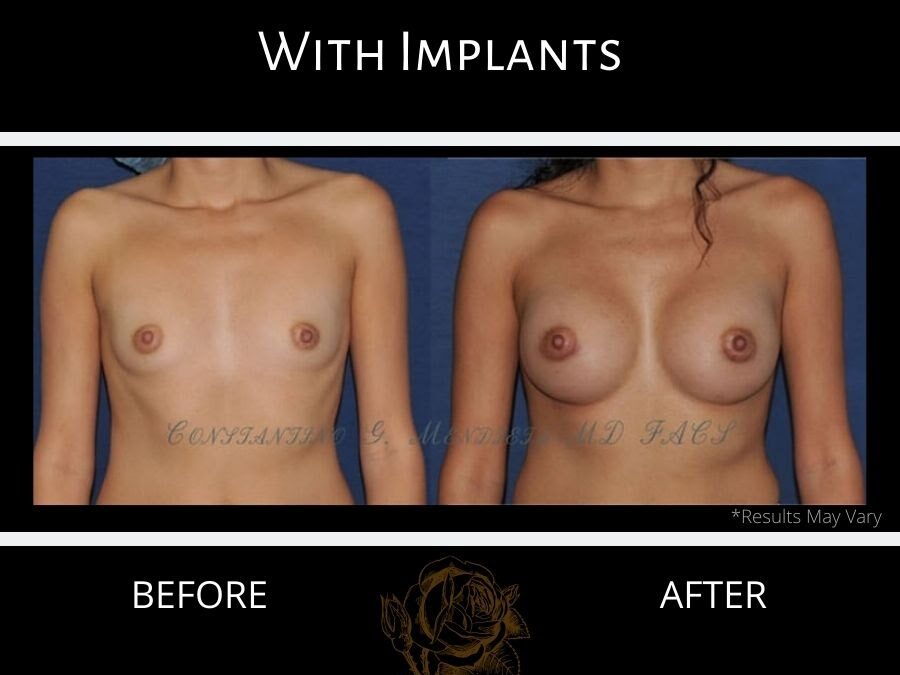 Want Better Boobs? Here Is Your Breast Augmentation Guide