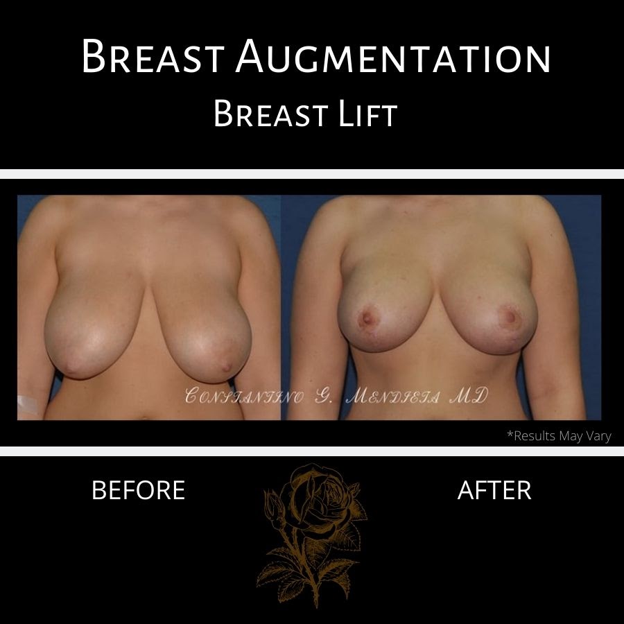  breast lift patient 13