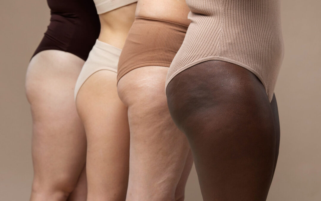 How to Get Rid of Stretch Marks