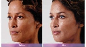 Before and After Image