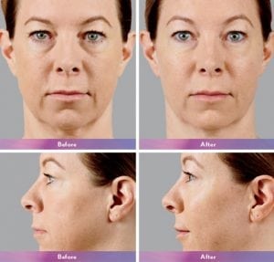 Before and After Image