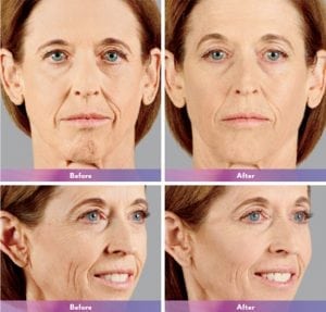 Before and After Image