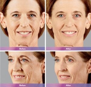 Before and After Image