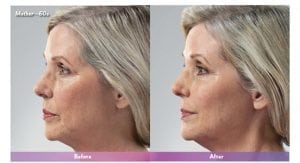 Before and After Image