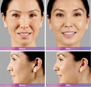 Before and After Image