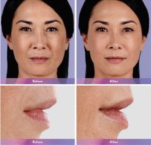 Before and After Image