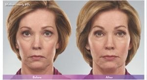 Before and After Image