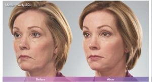 Before and After Image