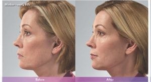 Before and After Image