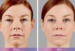 Before and After Image