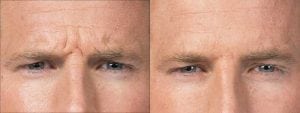 Before and After Image